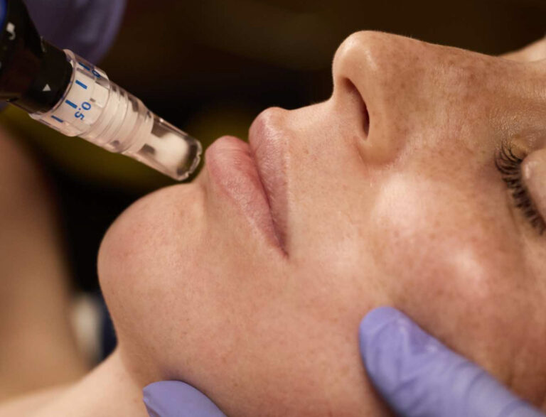microneedling-misu-zürich-02